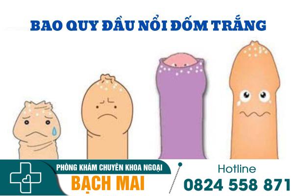 Lý giải nguyên nhân bao quy đầu nổi đốm trắng và cách khắc phục 2