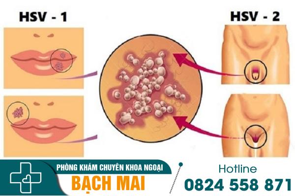 Nguyên nhân và biểu hiện của bệnh mụn rộp sinh dục 2