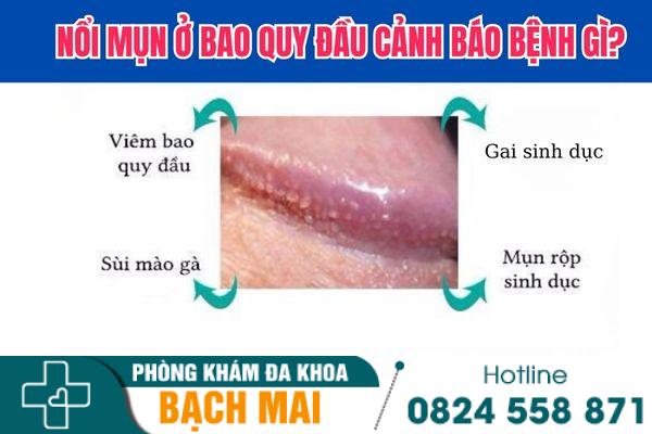 Nổi mụn ở bao quy đầu cảnh giác với nhiều bệnh nguy hiểm