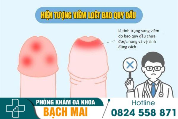Hiện tượng viêm loét bao quy đầu ở nam giới