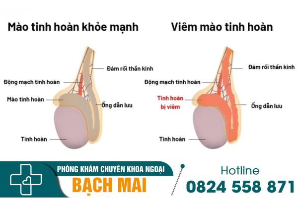 Viêm mào tinh hoàn và phương pháp điều trị hiện nay 2