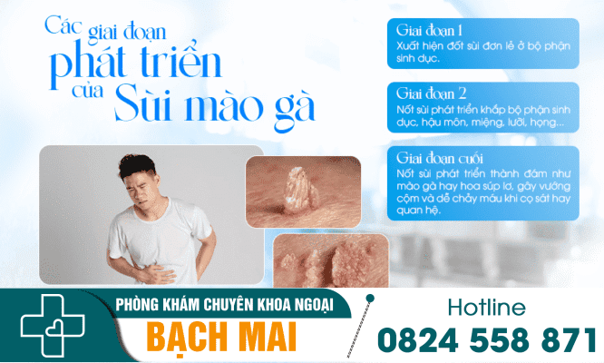 Sùi mào gà dương vật: Nguyên nhân và phương pháp điều trị 4 Dấu hiệu nhận biết sùi mào gà qua các giai đoạn