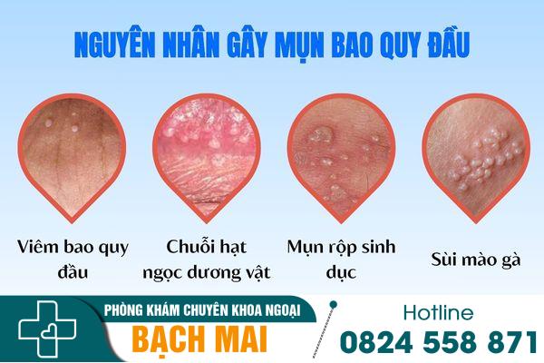 Nguyên nhân gây nổi mụn bao quy đầu
