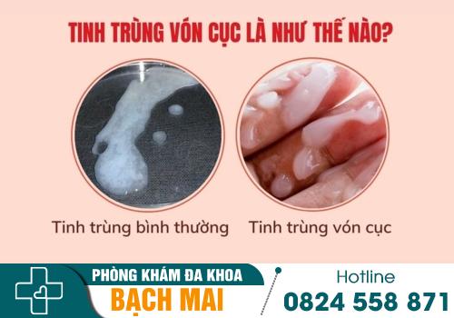 Xuất tinh vón cục - Cảnh báo sức khỏe sinh lý của nam giới 2
