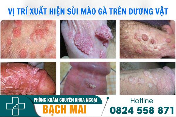 Sùi mào gà dương vật: Nguyên nhân và phương pháp điều trị 10 Vị trí xuất hiện sùi mào gà dương vật