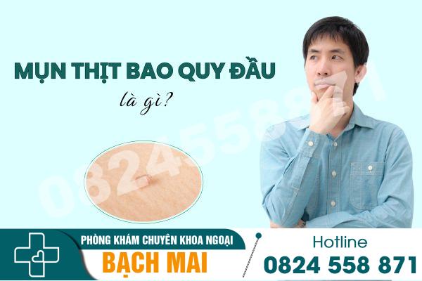 Mụn thịt bao quy đầu là gì?