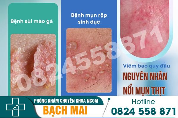 Dương vật nổi mụn thịt tiềm ẩn nhiều bệnh lý nguy hiểm 2